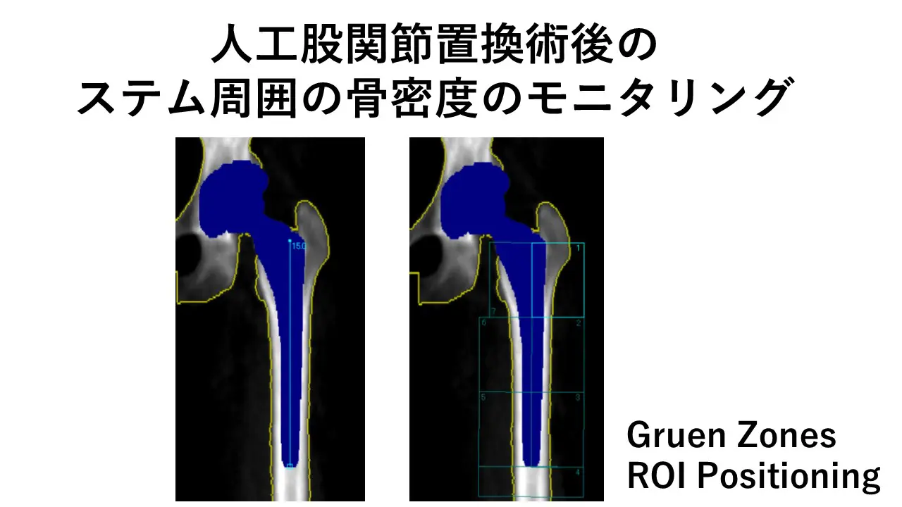 人工関節を受けられた方どうぞお気軽にご相談ください みえロコモリウマチクリニック