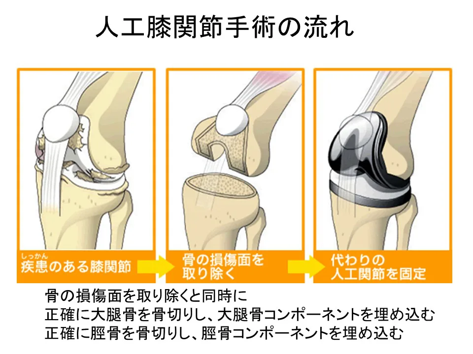 人工膝関節置換術（TKA: Total Knee Arthroplasty）｜みえロコモ 