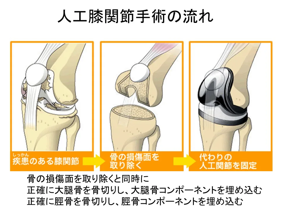 定番人気！ ☆裁断済☆TKA・UKA 人工膝関節置換術パーフェクト - 本